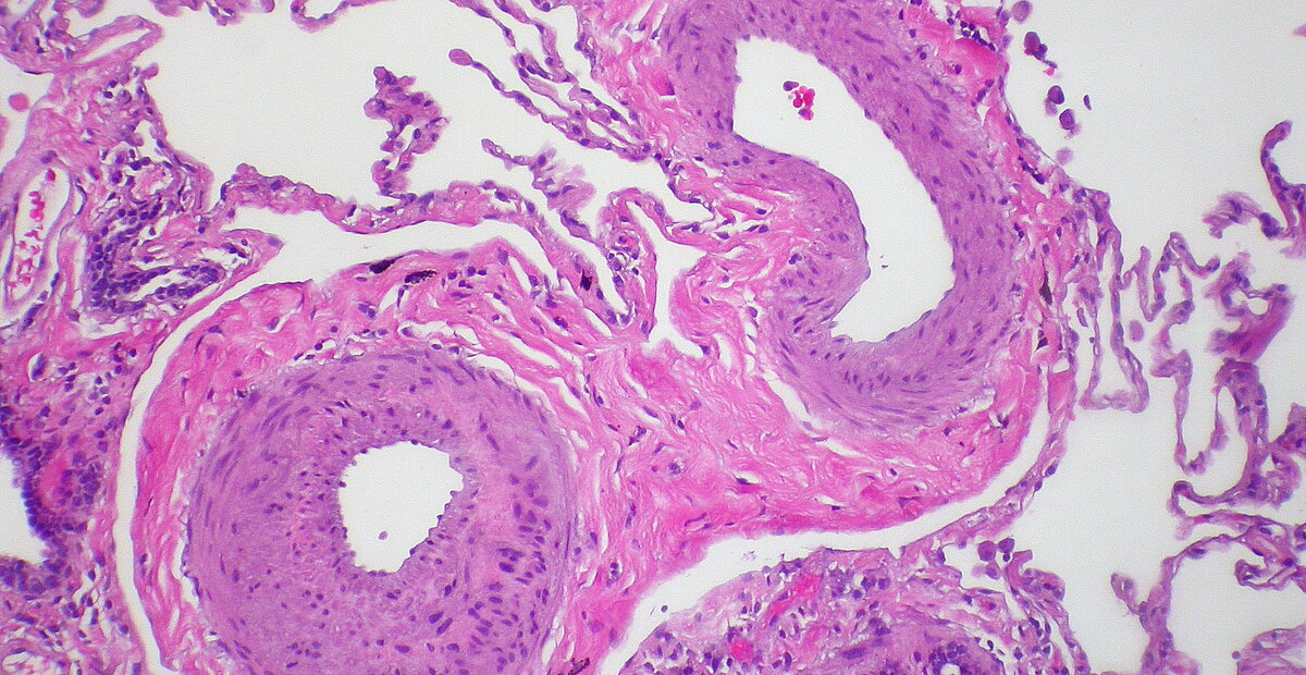 A histological image of lung tissue under the microscope showing arteries changes suggestive of PAH
